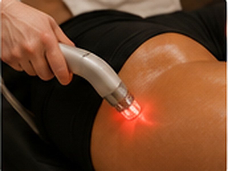 Laser Body Contouring — non-invasive treatment